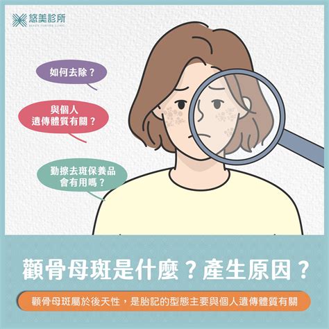 顴骨長斑|顴骨斑介紹與治療